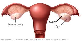 You have 2 ovaries, 1 on each side of your uterus. Ovarian Cysts Symptoms And Causes Mayo Clinic