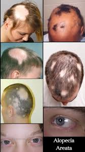 Alopecia areata is one type of hair loss that typically causes patches of baldness. Pin On Oddities Medical Anomalies