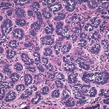 We did not find results for: Micronodular Basal Cell Carcinoma Small Rounded Nodules Of Basaloid Download Scientific Diagram