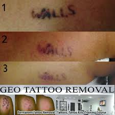 Laser tattoo removal at your clinic or salon is a great addition to the list of treatments you provide, and at mata courses our laser tattoo removal training course is second to none. Geo Laser Tattoo Removal Treatment à¤² à¤œà¤° à¤Ÿ à¤Ÿ à¤° à¤® à¤µà¤² à¤Ÿ à¤° à¤Ÿà¤® à¤Ÿ à¤² à¤œ à¤° à¤Ÿ à¤Ÿ à¤° à¤® à¤µà¤² à¤Ÿ à¤° à¤Ÿà¤® à¤Ÿ à¤Ÿ à¤Ÿ à¤• à¤² à¤œ à¤° à¤¤à¤•à¤¨ à¤• à¤¸ à¤¹à¤Ÿ à¤¨ à¤• à¤¸ à¤µ à¤ In Purasaivakkam Chennai Geotattoos