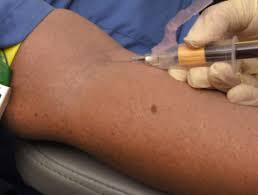 Dec 10, 2019 · blood tests can also give your doctor an idea of how well your organs are functioning and if they've been affected by cancer. Immunoglobulin E Tests Dermnet Nz