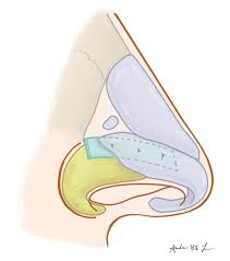 Lateral Alar Implants