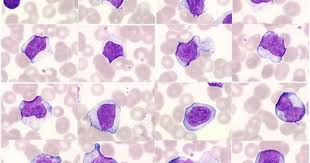 Laboratoire D Hematologie Cellulaire Du Chu D Angers Hematologie Laboratoire Moelle Osseuse