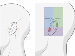 Image result for Ear Nerve Block