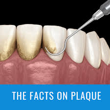 Image result for Plaque