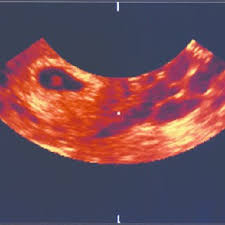 Us Transvaginal Mostrando Saco Gestacional Com Embriao Compativel Com Download Scientific Diagram