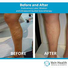 Pin On Varicose Veins