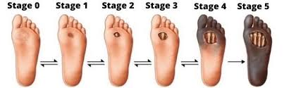 Image result for IDSA Diabetic Foot Wound Classification