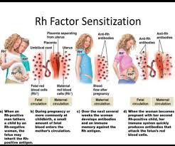 Image result for Rh Sensitization