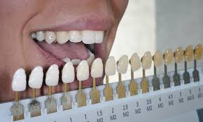 Image result for Tooth Discoloration