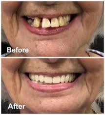 There are some that rush things and get dentures way too soon and they get a poor fitting set of dentures, and a sore mouth. Dentures Ottawa Denture Clinic Denturist Rockcliffe Dental