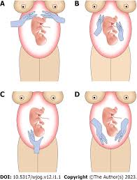 Image result for Breech Delivery