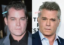 Ray Liotta Plastic Surgery Facelift Botox Hair Transplant