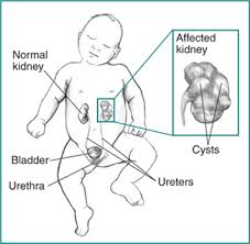 Kidney Dysplasia Niddk