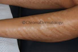 At results laser clinic doncaster, our fully qualified clinical therapists and registered cosmetic nurses offer a range of laser hair removal, skin treatments, body treatments & cosmetic injectable treatments for clients in doncaster and the surrounding suburbs of doncaster east, blackburn north, box hill north, templestowe and balwyn north. Laser Hair Removal Chroma Dermatology