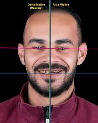 P.E.T. stands for Partial Extraction Therapy; a technique which promotes  the preservation of the original volume of the ridge at pontic or implant  sites by preserving partially the root of the old