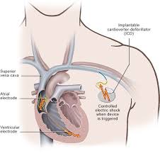 Image result for Internal Cardiac Defibrillator