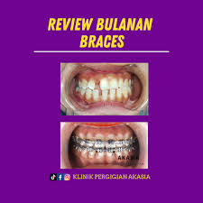 Klinik Pergigian Akasia - Teeth Braces, Whitening, Veneers @ Sungai Petani Saujana