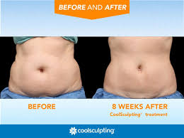 Pin On Coolsculpting