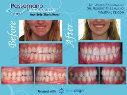 Pin On Invisalign Smile Transformations