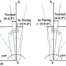 Image result for Out-toeing