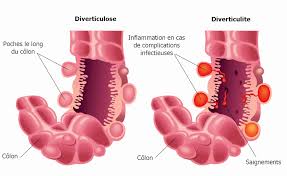 Voir la définition de péritonite dans le littré. Diverticulose Du Colon Symptomes Traitements Que Manger