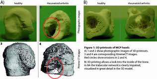 I'm not sure i understand what you mean, but basically all the foot bones were a single subtool in zbrush, that way i could dynamesh at a high resolution independently from the rest of the. Fri0225 Introduction Of 3d Printing Into Rheumatology Transferring Images From Arthritic Joints Into Models Annals Of The Rheumatic Diseases