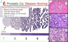 Image result for Prostate Cancer Histologic grading