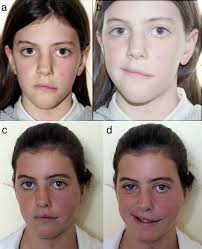 Facial animation in children with Moebius and Moebius-like syndromes