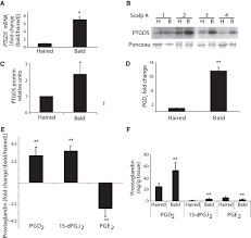 It reduces both the good and the bad prostaglandins equally. Prostaglandin D2 Inhibits Hair Growth And Is Elevated In Bald Scalp Of Men With Androgenetic Alopecia Science Translational Medicine