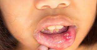 What do the early stages of mouth cancer look like? What Do The Early Stages Of Mouth Cancer Look Like Early Warning Signs Of Oral Cancer Include Mouth Sores White Or Red Patches And Tenderness Or Pain