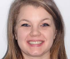 There are several different types of dental braces that may be recommended to improve alignment of teeth including traditional metal braces, ceramic braces, lingual braces and invisalign. Lingual Braces An Invisible Way To Straighten Teeth