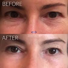 A fan to fan marketplace where you can safely, buy and sell real tickets. Tixel Rejuvenation Leading Specialists In London Perfect Eyes Ltd