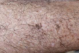 Image result for liver spots on legs