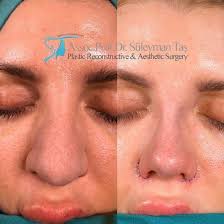 Thick Skin Bulbous Tip Rhinoplasty Assoc Prof Dr Suleyman Tas Rhinoplasty Nose Job Rhinoplasty Nose Jobs