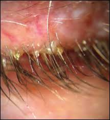Image result for demodex rosacea