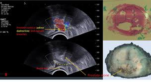 Benefits are payments from the government to people who need financial help. Seeing Prostate Cancer In A New Light News University Of Dundee