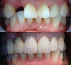 Maybe you would like to learn more about one of these? Crowns And Bridges Niles Il Dentist