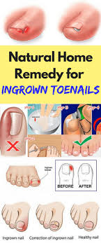 Natural Home Remedy For Ingrown Toenails Ingrown Toe Nail Ingrown Nail Toe Nails