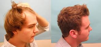 This showcases that hair transplants are safe when you hopefully, by now, you got an overall idea about the best hair transplant in india. 10 Best Hair Transplantation Clinics In India