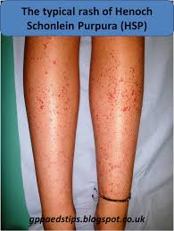 Palpable purpura is purpura than can be felt, due to inflammation of the blood vessels (vasculitis) Paediatrics For Primary Care And Anyone Else Henoch Shonlein Purpura Who What Where And When