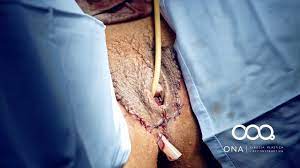 Cirugia de reasignacion de sexo hombre a mujer