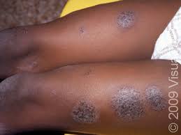 Image result for Eczema nummulare