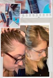 Hair loss in the hairline products and supplements?