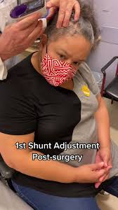 First Shunt Adjustment Post Surgery Update