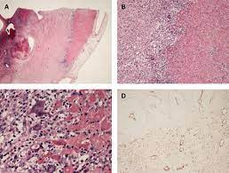 Myopericarditis 心脏损伤后心包炎 in english : å¿ƒè‚Œç‚Ž ç—‡çŠ¶ è¯Šæ–­å'Œæ²»ç–— Bmj Best Practice
