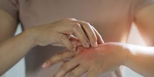 It works by killing the fungus or yeast or preventing its growth. Nizoral Cream Ketoconazole For Fungal Infections