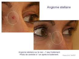 Learn vocabulary, terms and more with flashcards, games and other study tools. Laser Couperose Et Rougeurs Du Visage A Paris Au Centre Pmlaser