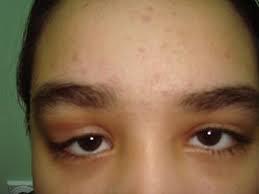 Image result for Dacryoadenitis