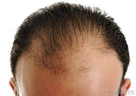 Compared to certain other types of anabolic steroid, anavar has very low levels of androgenic activity which means the potential for hair loss is far less. What Are Anavar Side Effects With Pictures